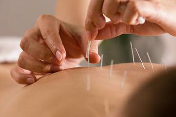 Dry Needling Treatment Image